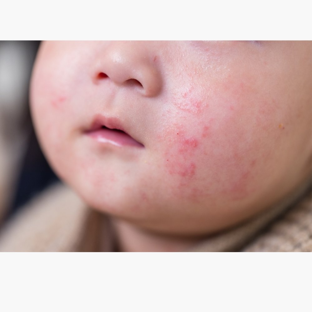 baby eczema