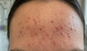 causes of Fungal acne guide